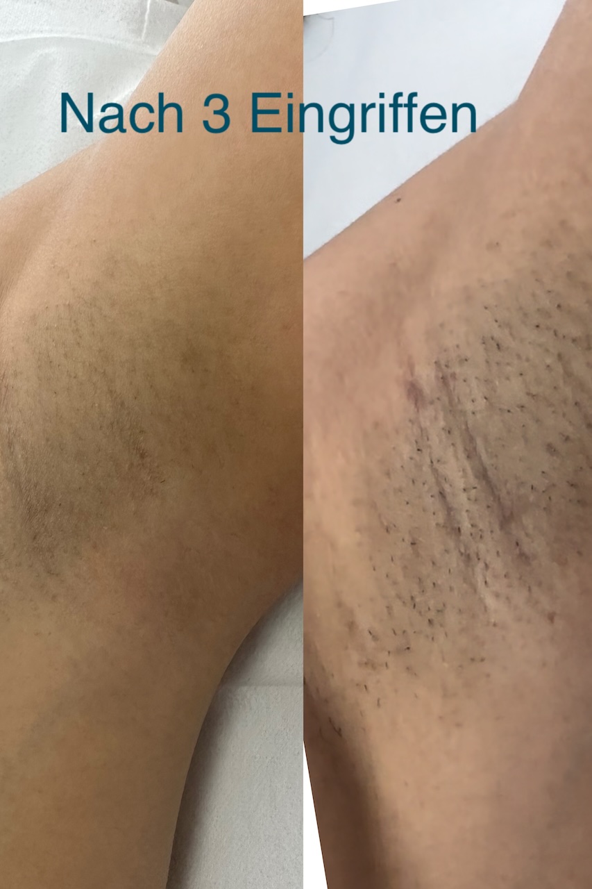 Laser hair removal before and after