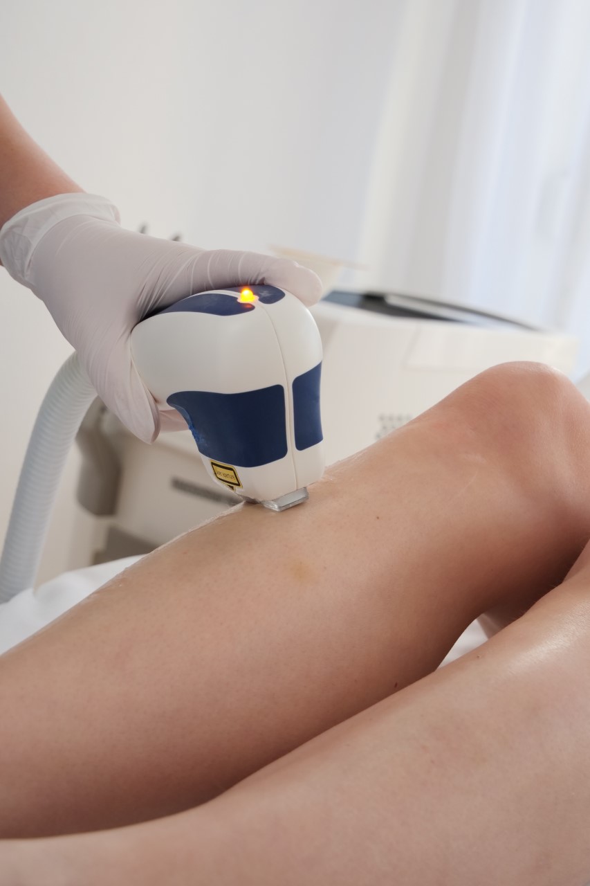 Laser hair removal